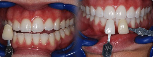 Diversen Prominent Kind Tanden bleken – Tandartspraktijk Mondzorg Clinics